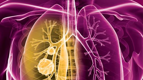 purple and gold lung cancer